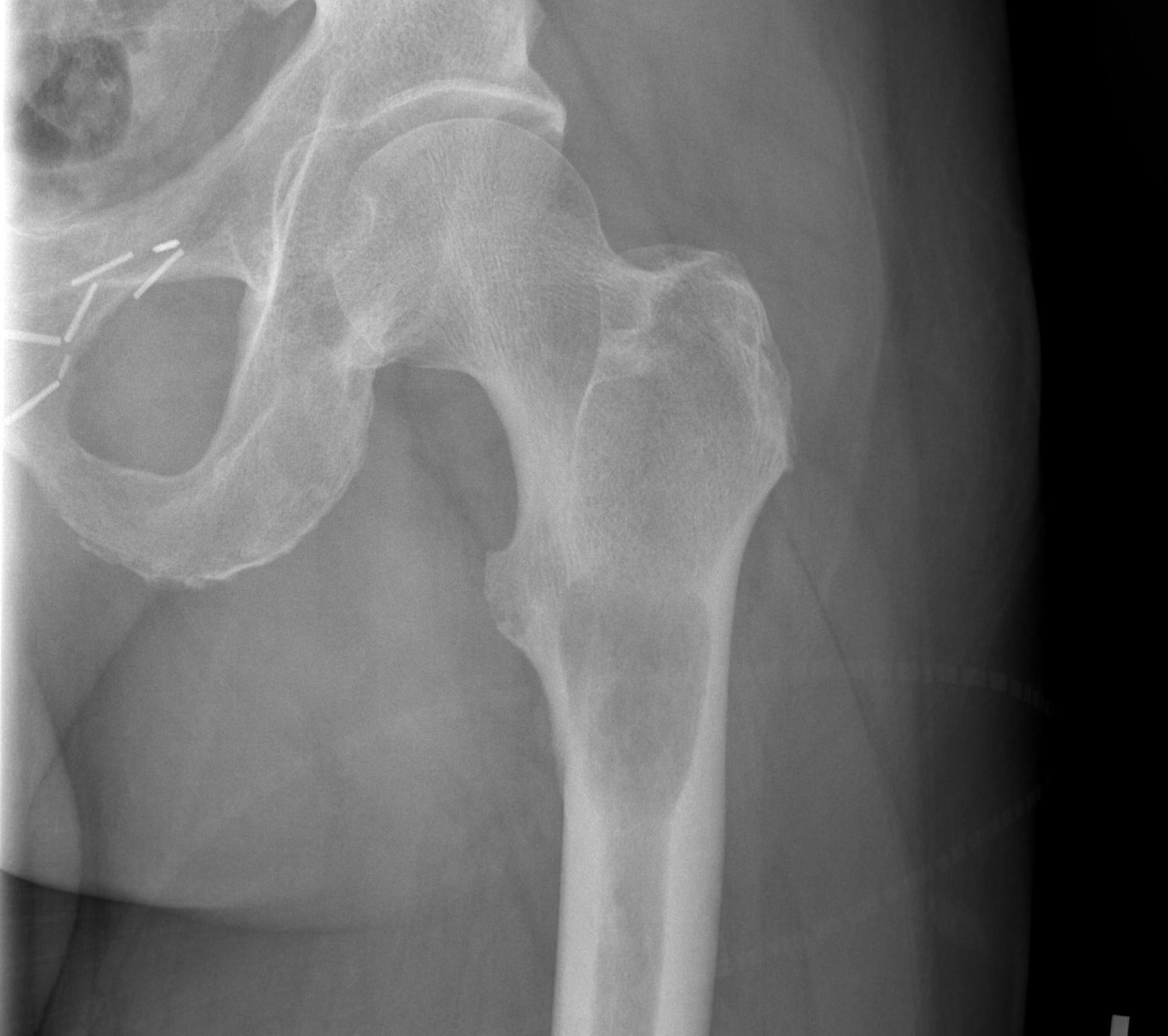 Subtrochanteric Metastasis and Nail0001